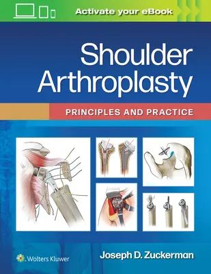 Artroplastyka stawu barkowego: Zasady i praktyka - Shoulder Arthroplasty: Principles and Practice