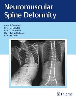 Nerwowo-mięśniowa deformacja kręgosłupa - Neuromuscular Spine Deformity