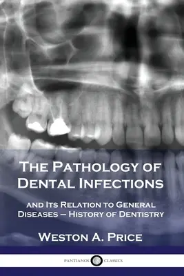 Patologia infekcji stomatologicznych i jej związek z chorobami ogólnymi - historia stomatologii - The Pathology of Dental Infections: and Its Relation to General Diseases - History of Dentistry