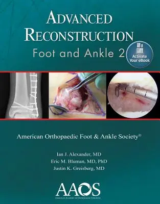 Zaawansowana rekonstrukcja: Stopa i staw skokowy 2: Druk + eBook - Advanced Reconstruction: Foot and Ankle 2: Print + eBook