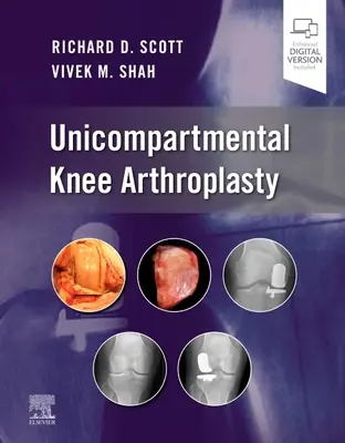 Jednoprzedziałowa endoprotezoplastyka stawu kolanowego - Unicompartmental Knee Arthroplasty