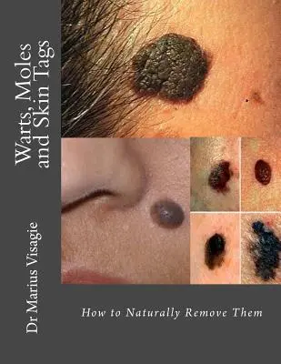 Brodawki, znamiona i pieprzyki: Jak je naturalnie usunąć - Warts, Moles and Skin Tags: How to Naturally Remove Them