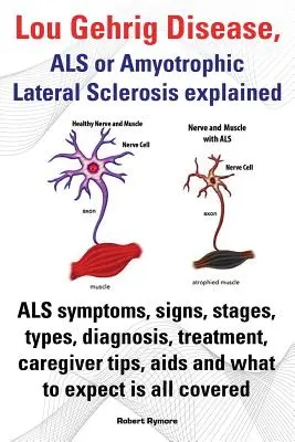 Choroba Lou Gehriga, ALS lub stwardnienie zanikowe boczne - wyjaśnienie. Objawy ALS, oznaki, etapy, rodzaje, diagnoza, leczenie, porady dla opiekunów, AIDS i inne. - Lou Gehrig Disease, ALS or Amyotrophic Lateral Sclerosis Explained. ALS Symptoms, Signs, Stages, Types, Diagnosis, Treatment, Caregiver Tips, AIDS and