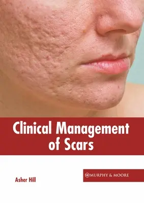 Kliniczne leczenie blizn - Clinical Management of Scars