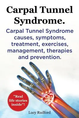 Zespół cieśni nadgarstka, Cts. Zespół cieśni nadgarstka przyczyny, objawy, leczenie, ćwiczenia, postępowanie, terapie i zapobieganie. - Carpal Tunnel Syndrome, Cts. Carpal Tunnel Syndrome Cts Causes, Symptoms, Treatment, Exercises, Management, Therapies and Prevention.