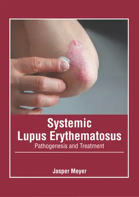 Toczeń rumieniowaty układowy: Patogeneza i leczenie - Systemic Lupus Erythematosus: Pathogenesis and Treatment