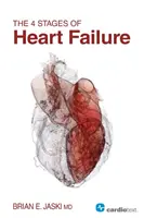 4 etapy niewydolności serca - The 4 Stages of Heart Failure