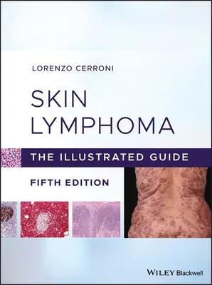 Chłoniak skóry: Ilustrowany przewodnik - Skin Lymphoma: The Illustrated Guide