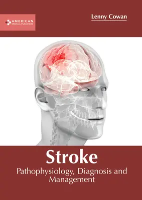 Udar mózgu: Patofizjologia, diagnostyka i leczenie - Stroke: Pathophysiology, Diagnosis and Management