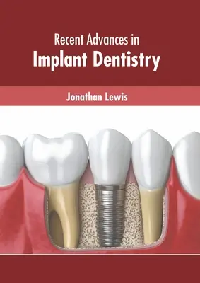 Najnowsze osiągnięcia w stomatologii implantologicznej - Recent Advances in Implant Dentistry