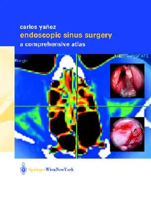 Endoskopowa chirurgia zatok: Kompleksowy atlas - Endoscopic Sinus Surgery: A Comprehensive Atlas