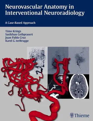 Anatomia nerwowo-naczyniowa w neuroradiologii interwencyjnej: Podejście oparte na przypadkach - Neurovascular Anatomy in Interventional Neuroradiology: A Case-Based Approach