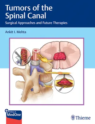 Guzy kanału kręgowego: Podejścia chirurgiczne i przyszłe terapie - Tumors of the Spinal Canal: Surgical Approaches and Future Therapies