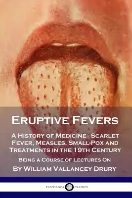 Eruptive Fevers: A History of Medicine - Scarlet Fever, Measles, Small-Pox and Treatments in the 19th Century - Being a Course of Lectu