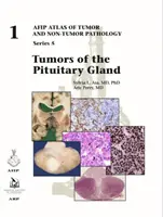 Nowotwory przysadki mózgowej - Tumors of the Pituitary Gland