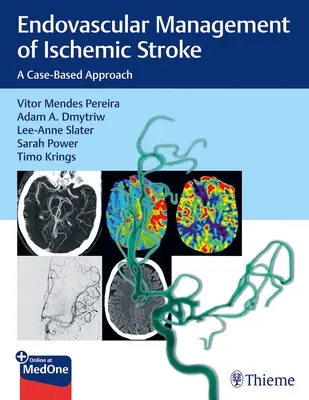 Wewnątrznaczyniowe leczenie udaru niedokrwiennego mózgu: A Case-Based Approach - Endovascular Management of Ischemic Stroke: A Case-Based Approach
