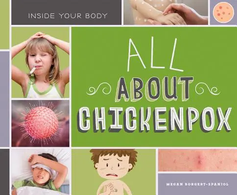 Wszystko o ospie wietrznej - All about Chickenpox