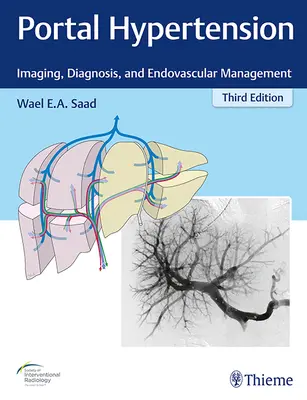 Nadciśnienie wrotne: Obrazowanie, diagnostyka i leczenie wewnątrznaczyniowe - Portal Hypertension: Imaging, Diagnosis, and Endovascular Management