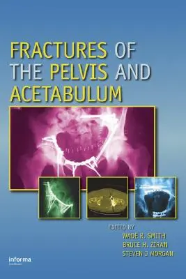 Złamania miednicy i panewki stawowej - Fractures of the Pelvis and Acetabulum