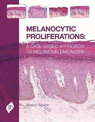 Rozrosty melanocytowe - podejście do diagnostyki czerniaka oparte na przypadkach - Melanocytic Proliferations - A Case-Based Approach to Melanoma Diagnosis