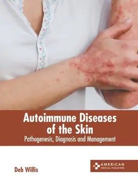 Autoimmunologiczne choroby skóry: Patogeneza, diagnostyka i leczenie - Autoimmune Diseases of the Skin: Pathogenesis, Diagnosis and Management