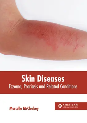 Choroby skóry: Egzema, łuszczyca i choroby pokrewne - Skin Diseases: Eczema, Psoriasis and Related Conditions