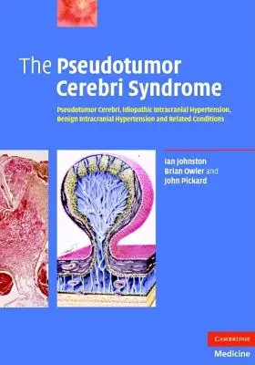 Zespół rzekomego guza móżdżku - The Pseudotumor Cerebri Syndrome