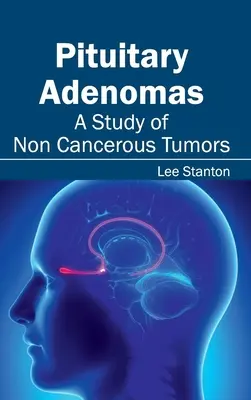 Gruczolaki przysadki mózgowej: Studium guzów nienowotworowych - Pituitary Adenomas: A Study of Non Cancerous Tumors