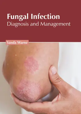 Zakażenie grzybicze: Diagnostyka i leczenie - Fungal Infection: Diagnosis and Management