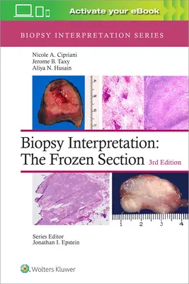 Interpretacja biopsji: Sekcja zamrożona - Biopsy Interpretation: The Frozen Section