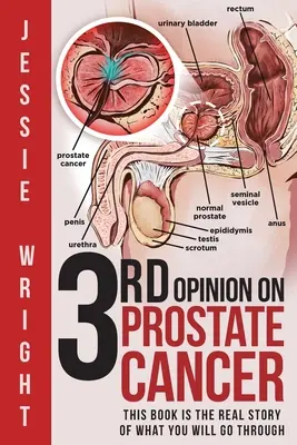 3. opinia na temat raka prostaty - 3rd Opinion on Prostate Cancer
