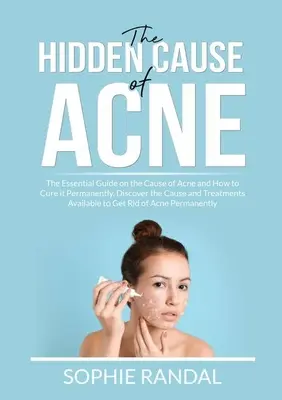 The Hidden Cause of Acne: The Essential Guide on the Cause of Acne and How to Cure it Permanently, Discover the Cause and Treatments Available t