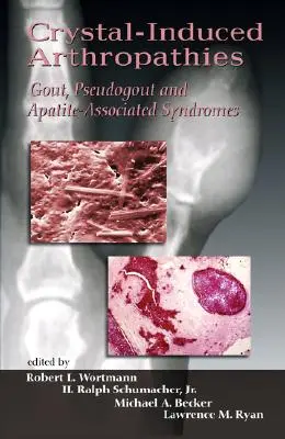 Artropatie wywołane kryształami: Dna moczanowa, rzekoma dna moczanowa i zespoły związane z apatytem - Crystal-Induced Arthropathies: Gout, Pseudogout and Apatite-Associated Syndromes