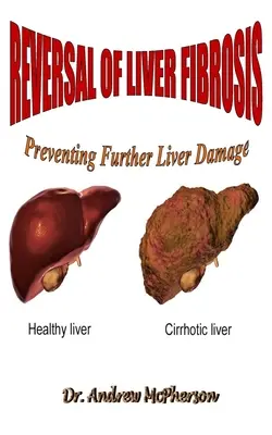Odwrócenie zwłóknienia wątroby: Zapobieganie dalszym uszkodzeniom wątroby - Reversal of Liver Fibrosis: Preventing Further Liver Damage