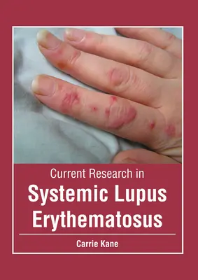 Aktualne badania nad toczniem rumieniowatym układowym - Current Research in Systemic Lupus Erythematosus