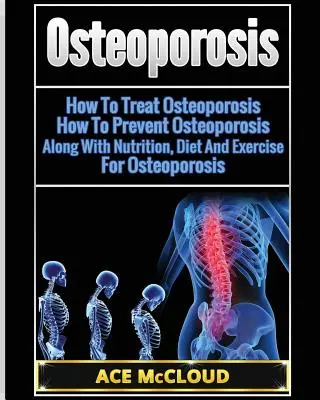 Osteoporoza: Jak leczyć osteoporozę: Jak zapobiegać osteoporozie: Wraz z odżywianiem, dietą i ćwiczeniami na osteoporozę - Osteoporosis: How To Treat Osteoporosis: How To Prevent Osteoporosis: Along With Nutrition, Diet And Exercise For Osteoporosis