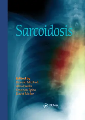 Sarkoidoza - Sarcoidosis