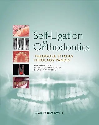 Samoligaturowanie w ortodoncji: Oparte na dowodach podejście do biomechaniki i leczenia - Self-Ligation in Orthodontics: An Evidence-Based Approach to Biomechanics and Treatment