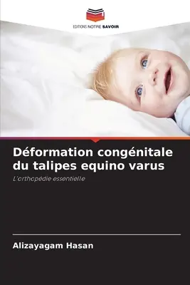 Deformacja wrodzona talipes equino varus - Dformation congnitale du talipes equino varus