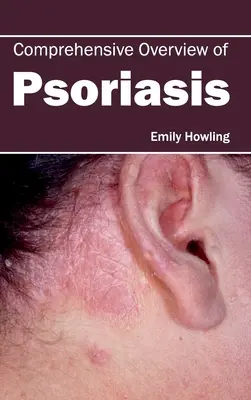 Kompleksowy przegląd łuszczycy - Comprehensive Overview of Psoriasis