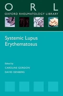 Toczeń rumieniowaty układowy - Systemic Lupus Erythematosus