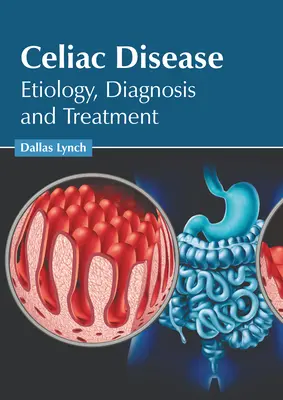 Celiakia: Etiologia, diagnoza i leczenie - Celiac Disease: Etiology, Diagnosis and Treatment