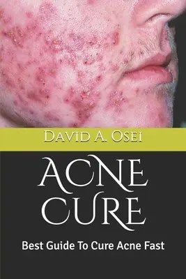 Leczenie trądziku: najlepszy przewodnik po szybkim leczeniu trądziku - Acne Cure: Best Guide To Cure Acne Fast