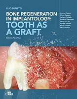 Regeneracja kości w implantologii - ząb jako przeszczep - Bone regeneration in implantology - tooth as a graft
