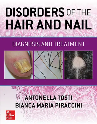 Zaburzenia włosów i paznokci: Diagnoza i leczenie - Disorders of the Hair and Nail: Diagnosis and Treatment
