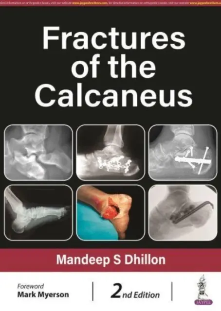 Złamania kości piętowej - Fractures of the Calcaneus