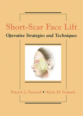Short-Scar Face Lift: Strategie i techniki operacyjne - Short-Scar Face Lift: Operative Strategies and Techniques